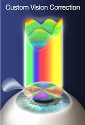 LASIK Walnut Creek