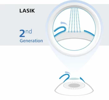 LASIK eye surgery graphic
