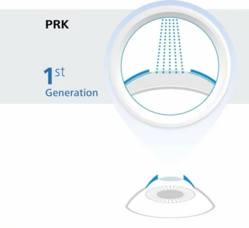 PRK Eye Surgery Graphic